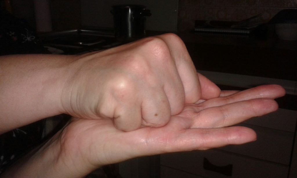 mano algodistrofica post trattamento neuroreset