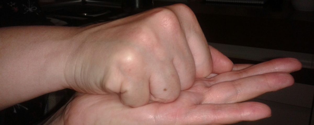 mano algodistrofica post trattamento neuroreset