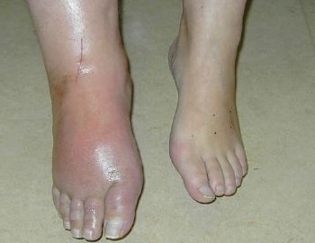 cura per l'algodistrofia neuroreset fabrizio la rosa