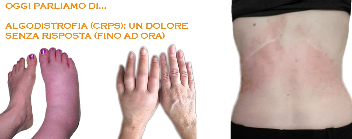 Algodistrofia (CRPS): un dolore senza risposta (fino ad ora)